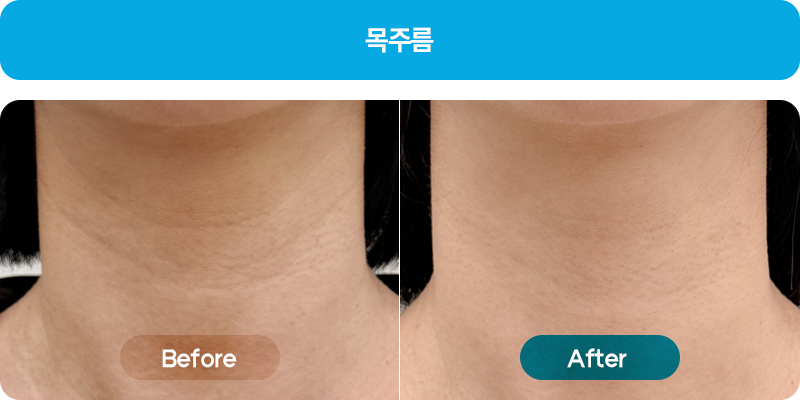 쥬브젠비포애프터1