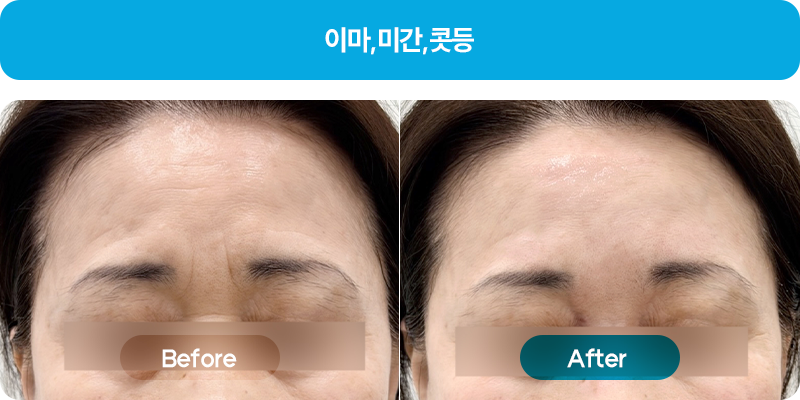 쥬브젠비포애프터4