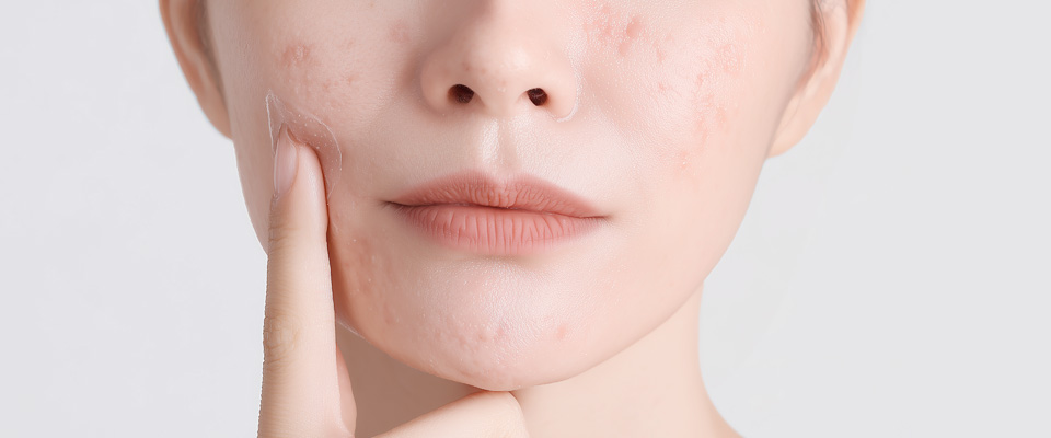 여드름 정의 이미지