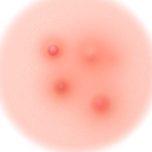 여드름포인트 이미지2