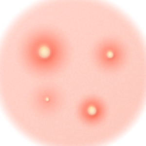 여드름포인트 이미지3