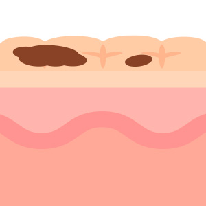 기미 색소포인트 이미지1