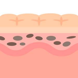 기미 색소포인트 이미지2