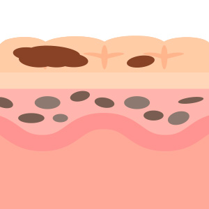 기미 색소포인트 이미지3