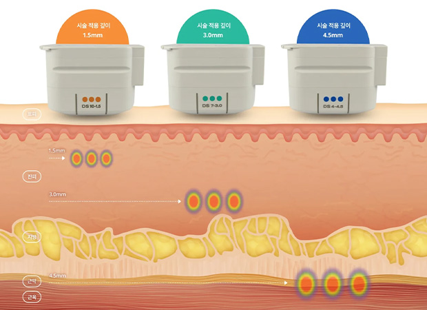 울쎄라피프라임포인트 이미지1