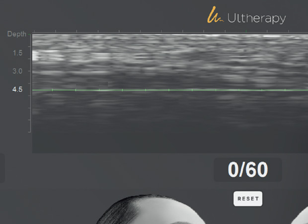 울쎄라피프라임포인트 이미지2